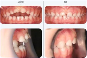 Preventieve pre-orthodontie met het Myobrace® Systeem voor en na