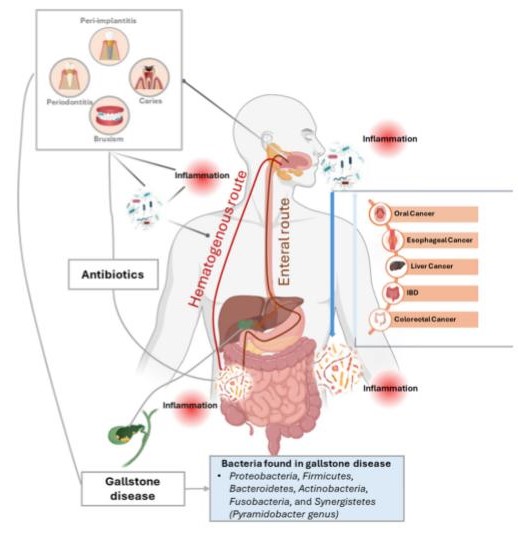 Infographic over mondmicrobioom, darmmicrobioom en systemische ontstekingen bij biologische tandheelkunde